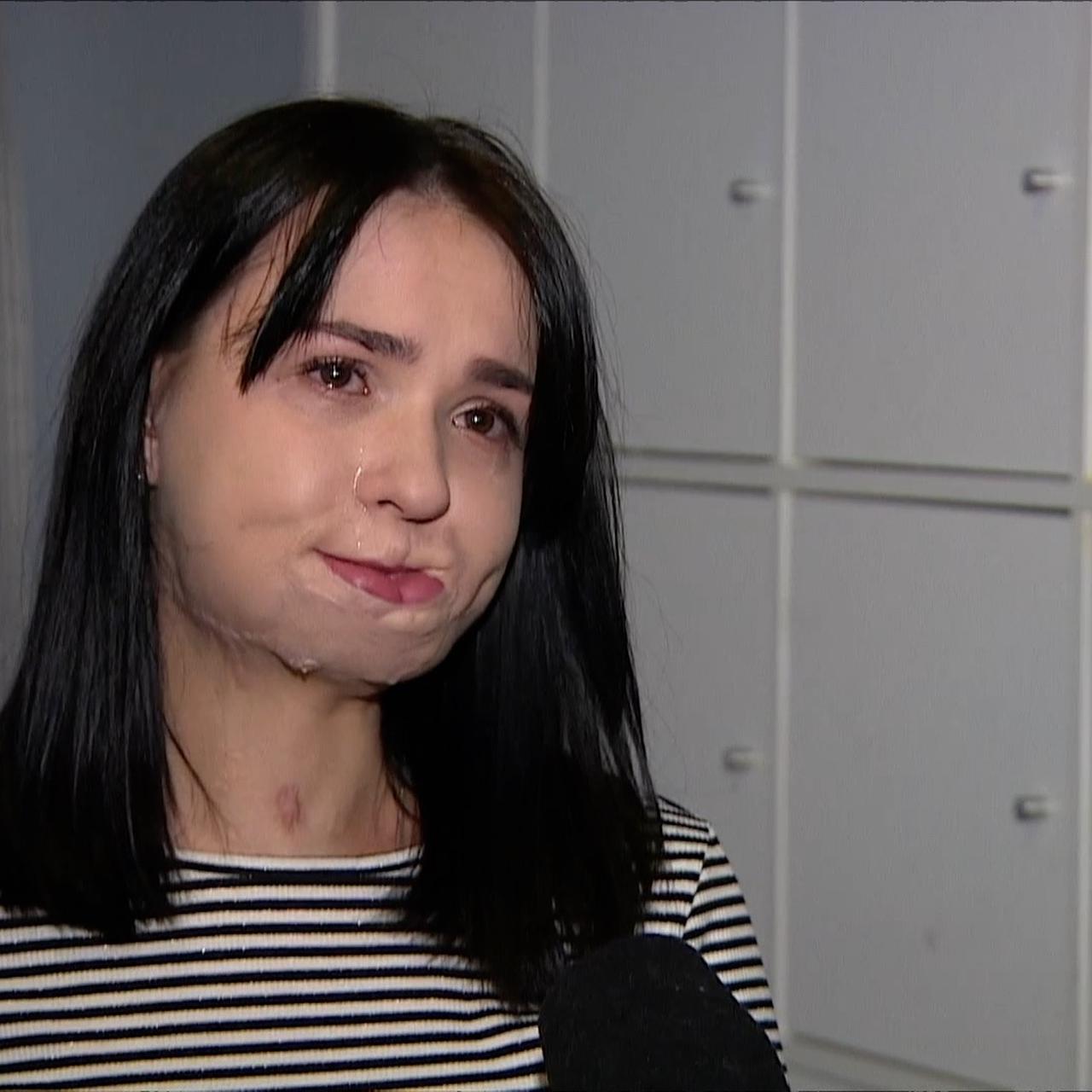 Польські хірурги відновили понівечене обстрілами обличчя 24-річної жительки Миколаївщини