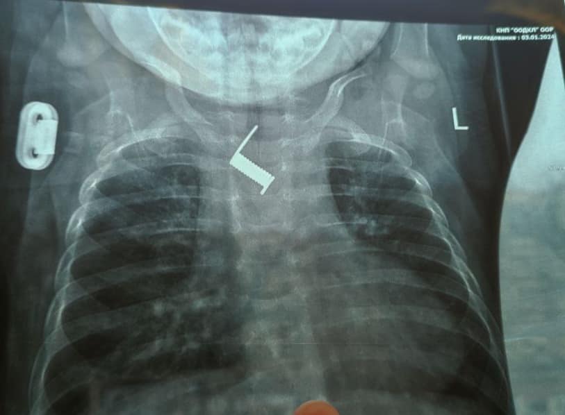 В Одесі лікарі витягнули зі стравоходу 6-місячного малюка металеву пружинку